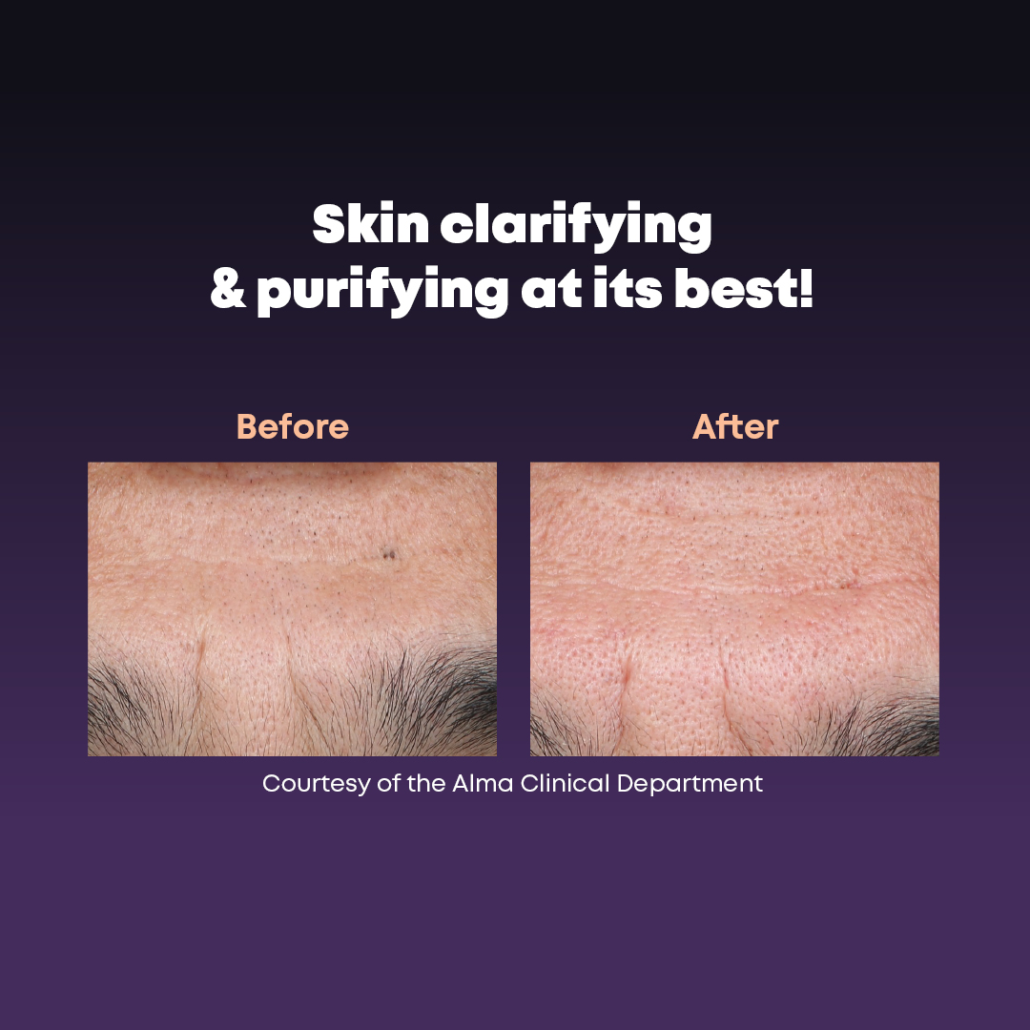 DermaClear Vorher Nachher Stirn DermaClear Vorher Nachher Stirn