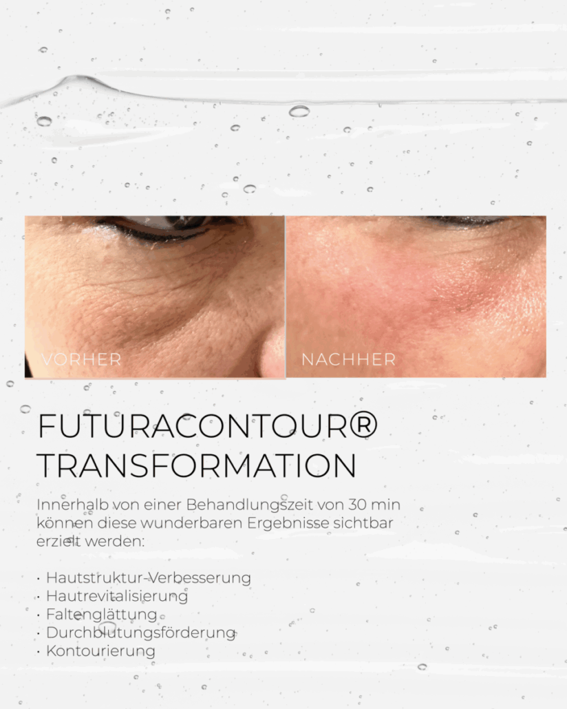 FUTURACONTOUR® Transformation Vorher-Nachher TRANSFORMATION VORHER-NACHHER Gesichtsbehandlung
