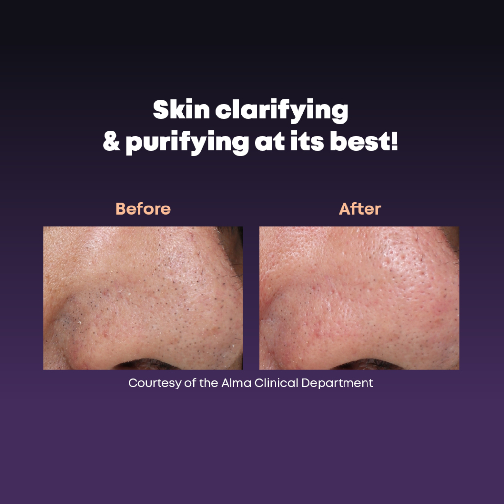 DermaClear Vorher Nachher 2