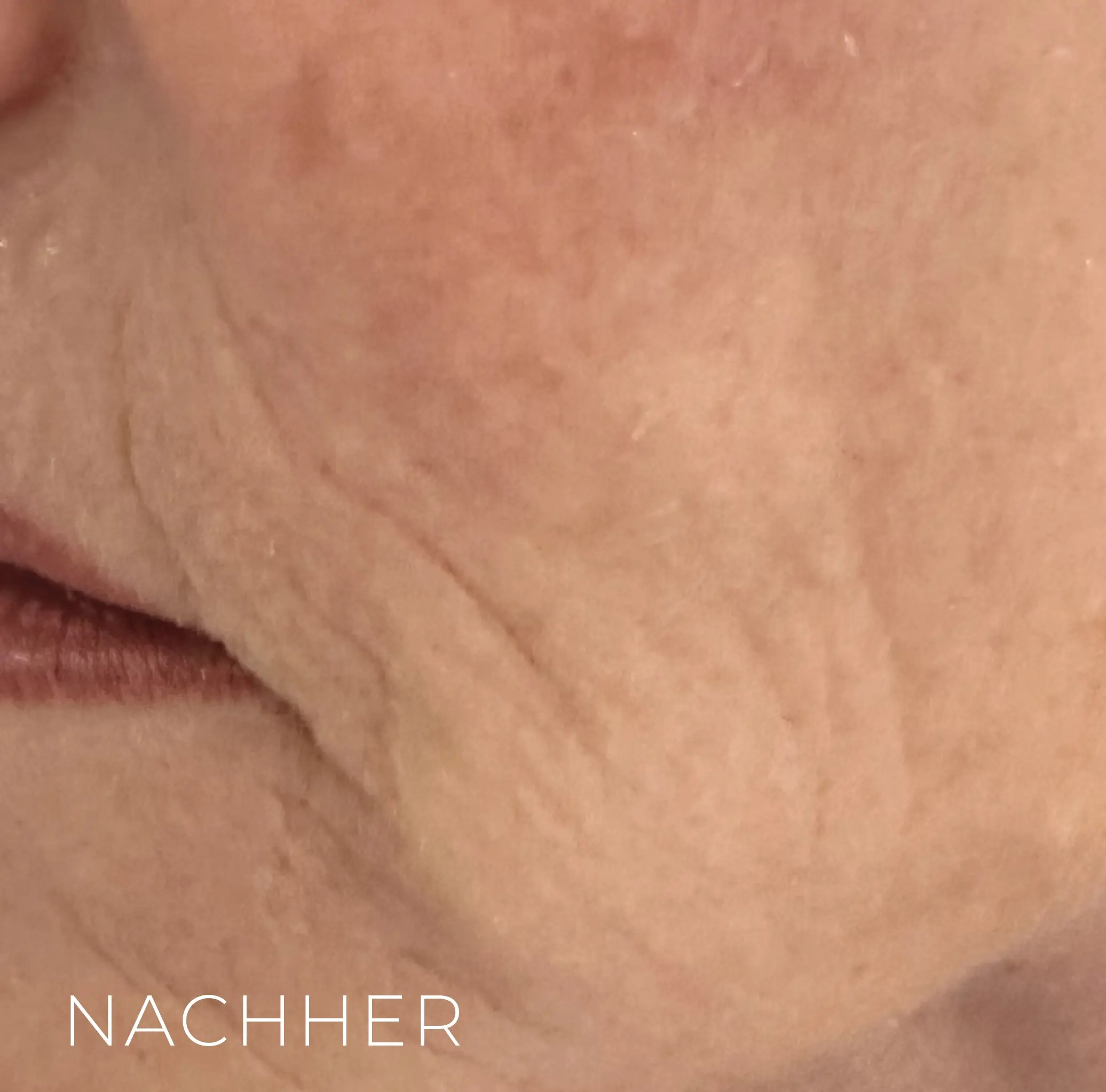 Nachher GESICHT