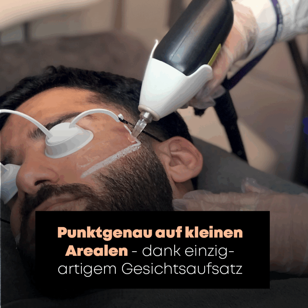 Bartkontur dauerhaft mit Laser Haarentfernung