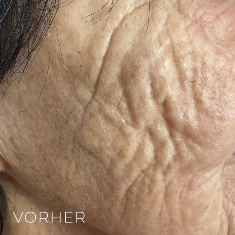 Vorher Gesichtsbehandlung