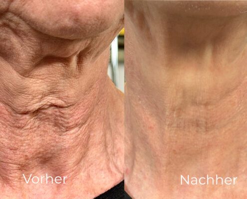 Hals Vorher/Nachher