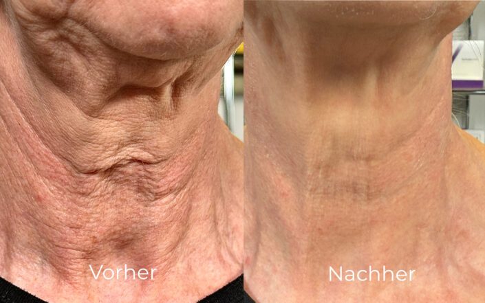 Hals Vorher/Nachher