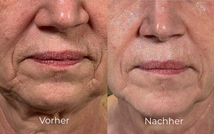Gesicht Vorne vorher nachher