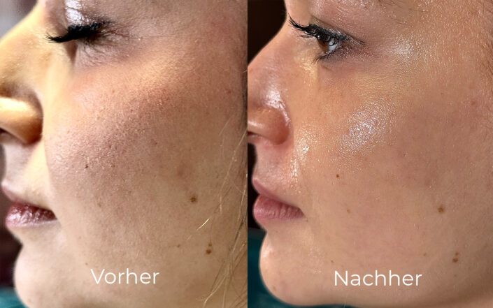 Gesicht Seite vorher nachher