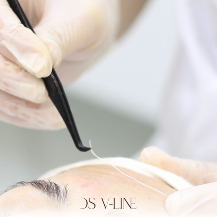 Kollagenfadenlifting einlegen eines Faden