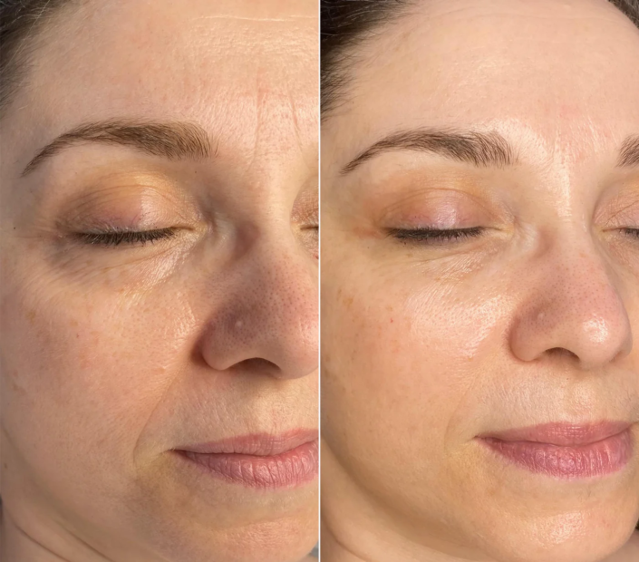 Kollagenfädenbehandlung vorher-nachher